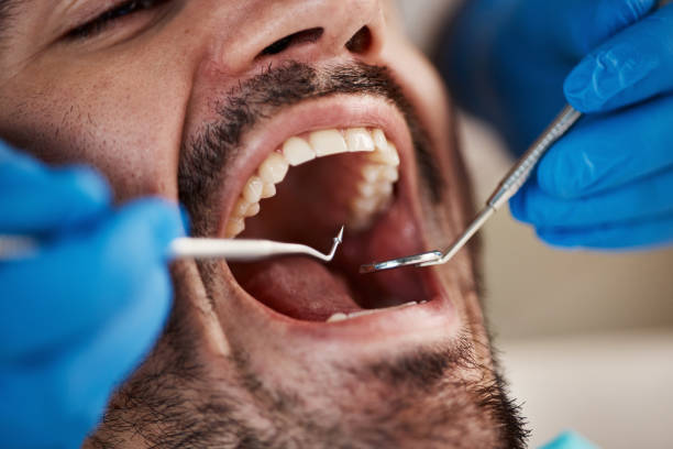 Best Emergency Dental Care for Abscessed Tooth in Peachtree City, GA